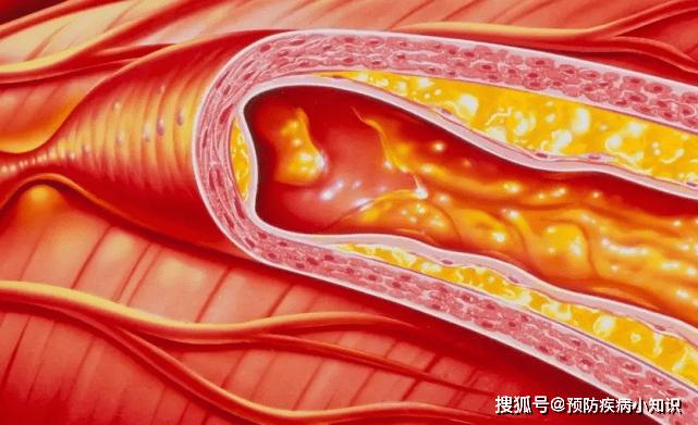 Loại thực phẩm chứa lượng cholesterol cực lớn, ăn nhiều nhồi máu não thường &#34;gõ cửa&#34; - 3