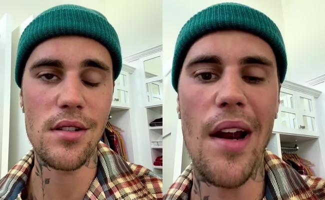 Justin Bieber bị liệt nửa mặt, liên tục hoãn show vì lý do này - 1