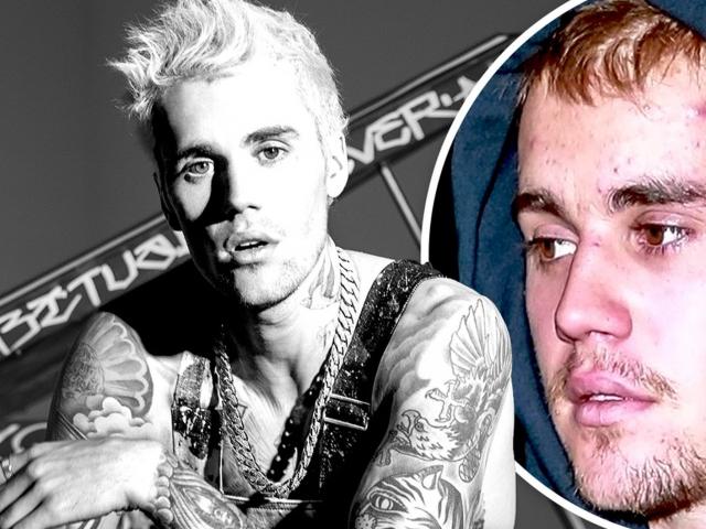 ”Hoàng tử nhạc Pop” Justin Bieber mắc căn bệnh lạ, khó chẩn đoán nhưng hậu quả cực nghiêm trọng