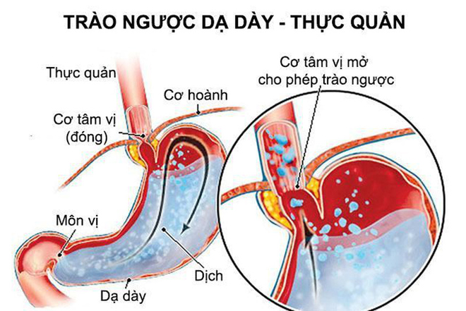 Đầy hơi, chướng bụng liên tục - Lối thoát nào cho người bệnh trào ngược dạ dày? - 2