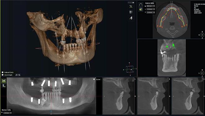 Phục hình toàn bộ răng hàm trên bằng trồng răng implant All – On - 6 và 4 trụ implant đơn lẻ hàm dưới