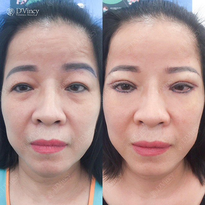 Cắt sửa mí tại VTM D’Vincy có tốt như quảng cáo?