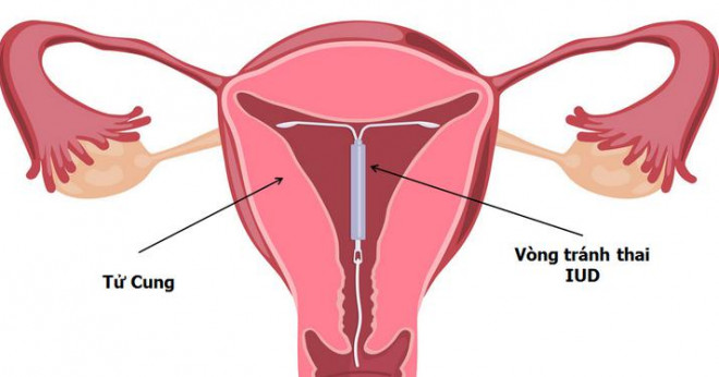 Lý giải 6 băn khoăn thường gặp về "chuyện ấy" khi phụ nữ đặt vòng tránh thai - 2