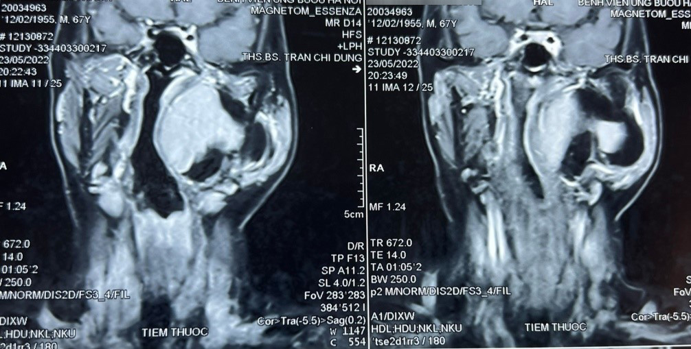Hình ảnh chụp cộng hưởng từ khối u khoảng bên họng của bệnh nhân.