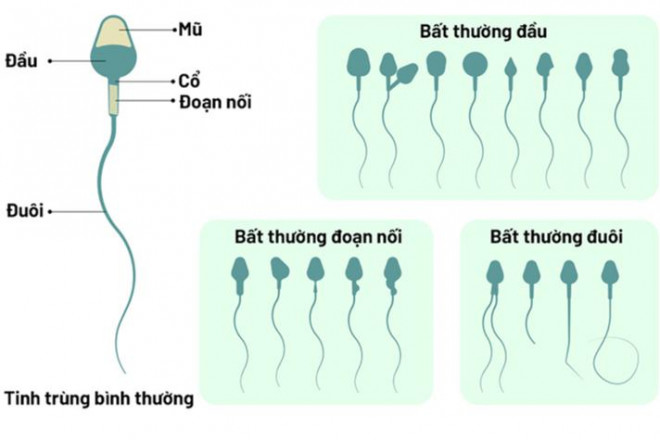 Tinh trùng bất thường ảnh hưởng đến khả năng sinh sản.