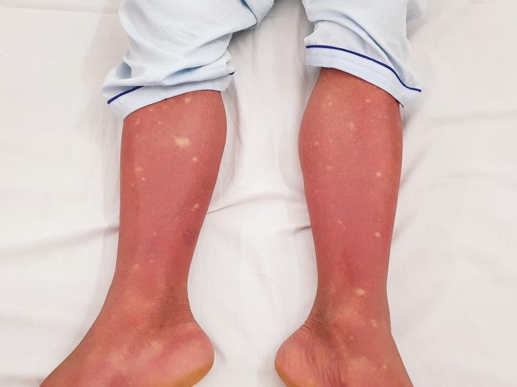 Hình ảnh xuất huyết trên chân của bệnh nhân sốt xuất huyết.