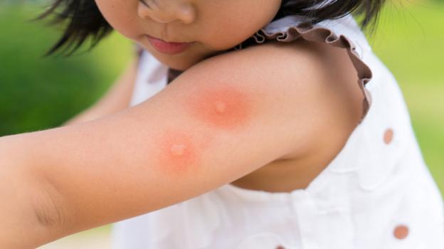 Trẻ em là đối tượng rất dễ bị muỗi đốt.