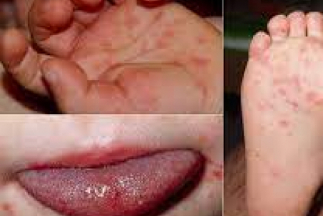Bệnh tay chân miệng có thể biến chứng nguy hiểm, cần đưa vào viện nếu có 3 dấu hiệu này