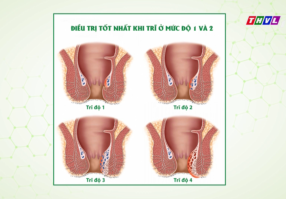 Chuyên gia giải đáp: Khi nào nên điều trị bệnh trĩ để tránh phẫu thuật? - 2