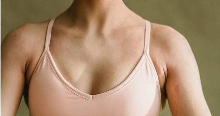 Thiếu nữ 17 tuổi mừng thầm vì ngực đầy đặn hơn, đi khám liền nhận kết quả gây sốc - 1