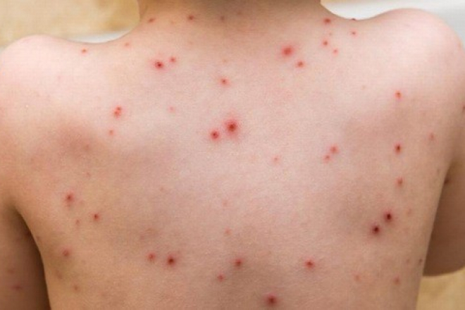 Hà Nội: Dịch thủy đậu bùng phát mạnh, sắp chạm ngưỡng 1.000 ca - 1