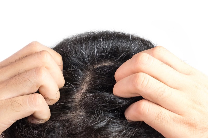 Các phương pháp điều trị hói đầu ở nam giới