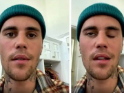 Sức khỏe đời sống - Hội chứng bệnh tưởng lạ mà quen khiến Justin Bieber bị liệt nửa mặt