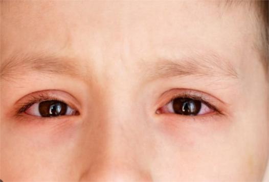 Ngứa mắt và đau mắt đỏ có thể là triệu chứng mới của COVID-19 - 2