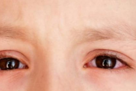 Ngứa mắt và đau mắt đỏ có thể là triệu chứng mới của COVID-19