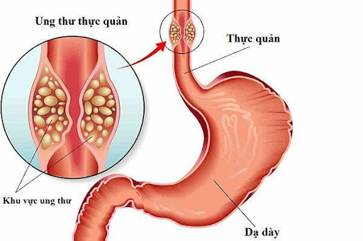 Cảnh báo ung thư thực quản: Ai đang bị nuốt nghẹn, tức ngực, khó thở vì trào ngược cần đọc ngay! - 3