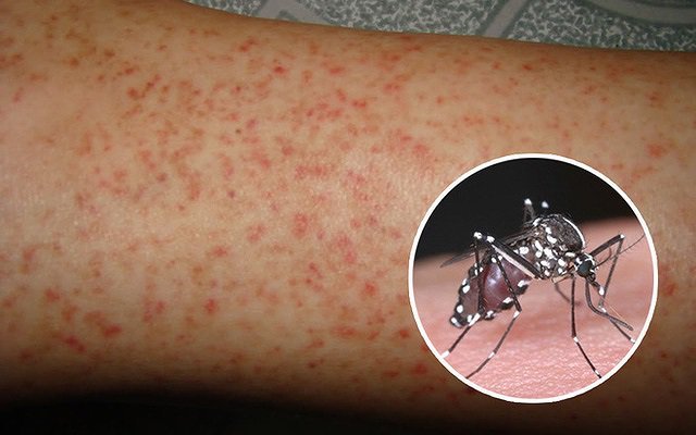 Sốt xuất huyết: Dấu hiệu cảnh báo nguy hiểm cần nhập viện ngay - 1
