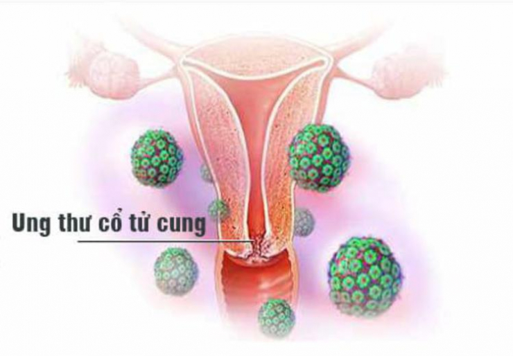 Không phải ai mắc HPV cũng sẽ bị ung thư cổ tử cung, nhưng hầu như toàn bộ người mắc ung thư cổ tử cung đều được phát hiện có HPV.