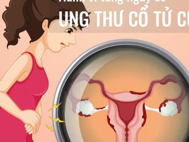 [Infographic] - Những hành vi làm tăng nguy cơ ung thư cổ tử cung