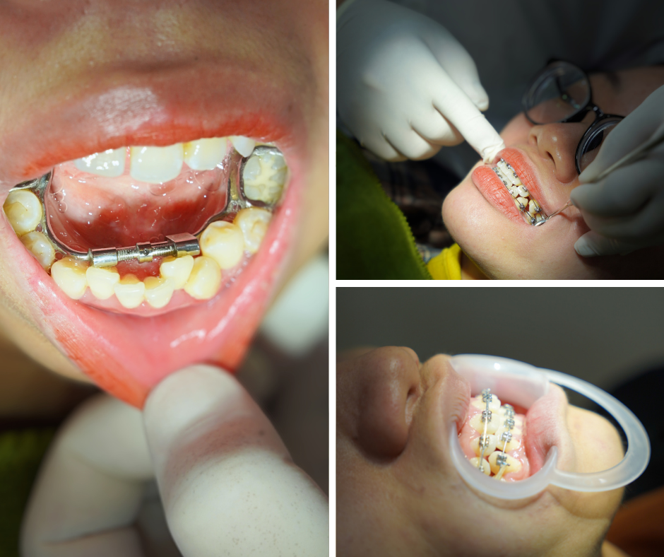 Bác sĩ Trần Tiến Mạnh chia sẻ những nguyên nhân gây đau buốt khi niềng răng và cách khắc phục - 2
