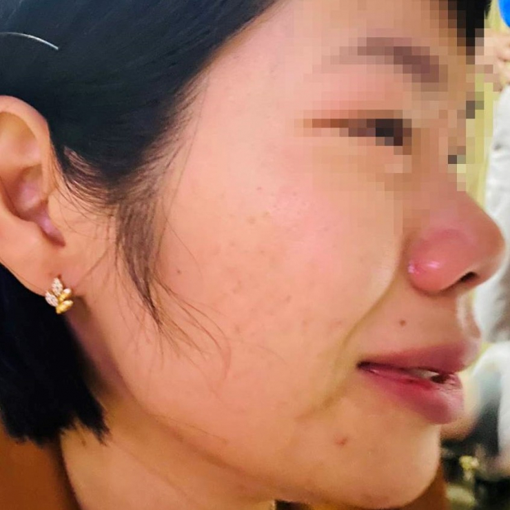 Cô Vũ Thị Kim Quy phản ánh bị 1 thầy giáo đánh gây thương tích