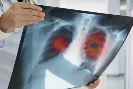 Tìm ra thuốc điều trị ung thư phổi giảm 51% nguy cơ tử vong