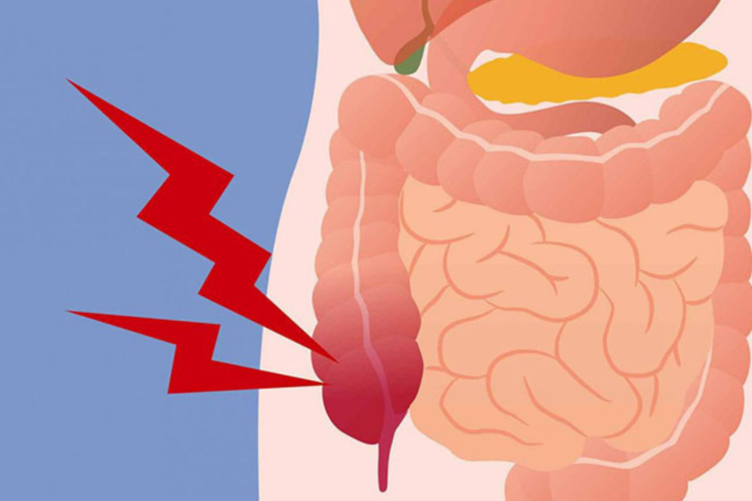 Nếu cơ địa đại tràng suy yếu, nguy cơ mắc bệnh đại tràng là rất cao