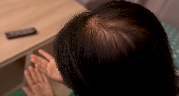 Nhuộm tóc liên tục nửa tháng 1 lần, người phụ nữ bị rụng tóc hói cả đầu - 2