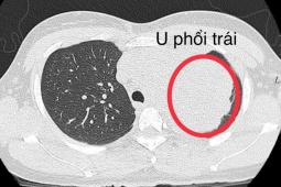 Đi khám vì đau bả vai, người phụ nữ trẻ mắc ung thư phổi