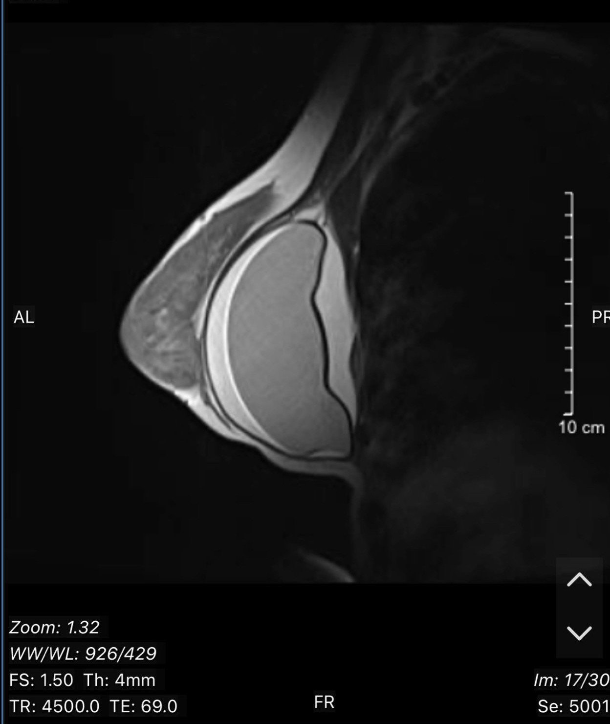 Hình ảnh chụp MRI của bệnh nhân bị vỡ túi ngực.