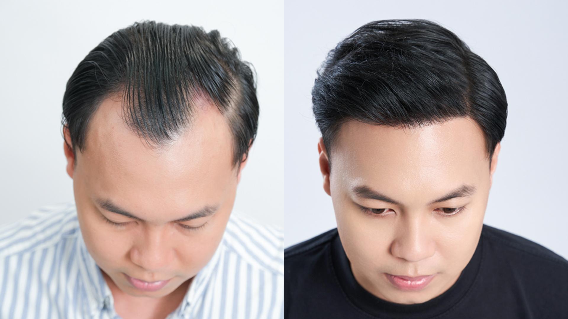 Cấy tóc tự thân giúp cho hàng nghìn người thoát khỏi hói đầu