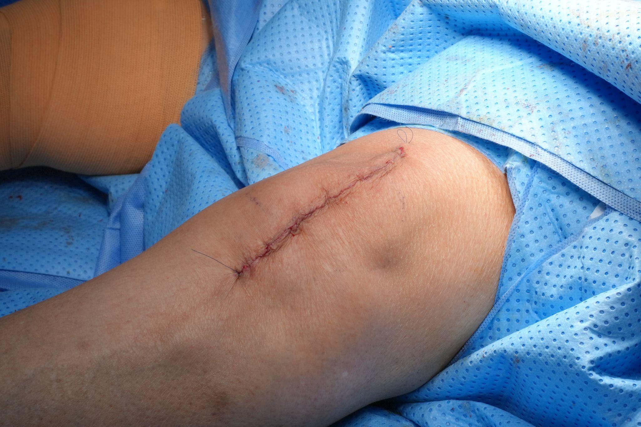 Đường mổ độc quyền chỉ 12 cm không cắt gân cơ, đảm bảo thẩm mỹ cho bệnh nhân sau thay khớp gối.