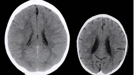 Kết quả nghiên cứu cho thấy trẻ hay bị phụ huynh la mắng (bên phải) có não bộ nhỏ hơn rất nhiều so với bạn đồng trang lứa.