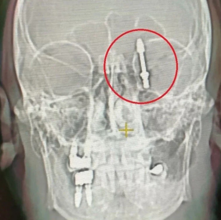 Đi khám răng, người đàn ông bị nha sĩ đẩy ốc vít lên tận não - 2