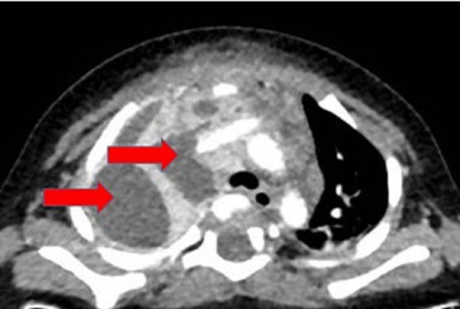 CT-Scan ngực cho thấy khối áp xe rất lớn ở vùng trung thất màng phổi bên phải (ảnh: BVCC)