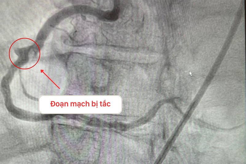 Vị trí động mạch bị tắc nghẽn