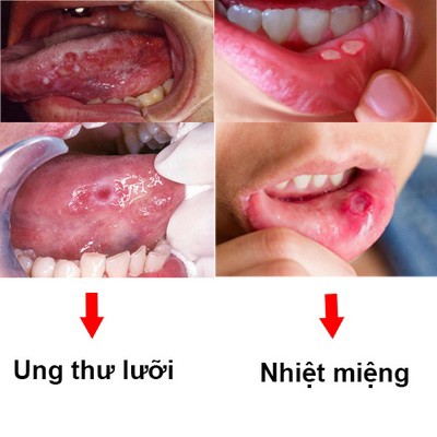 Phân biệt ung thư lưỡi và nhiệt miệng.