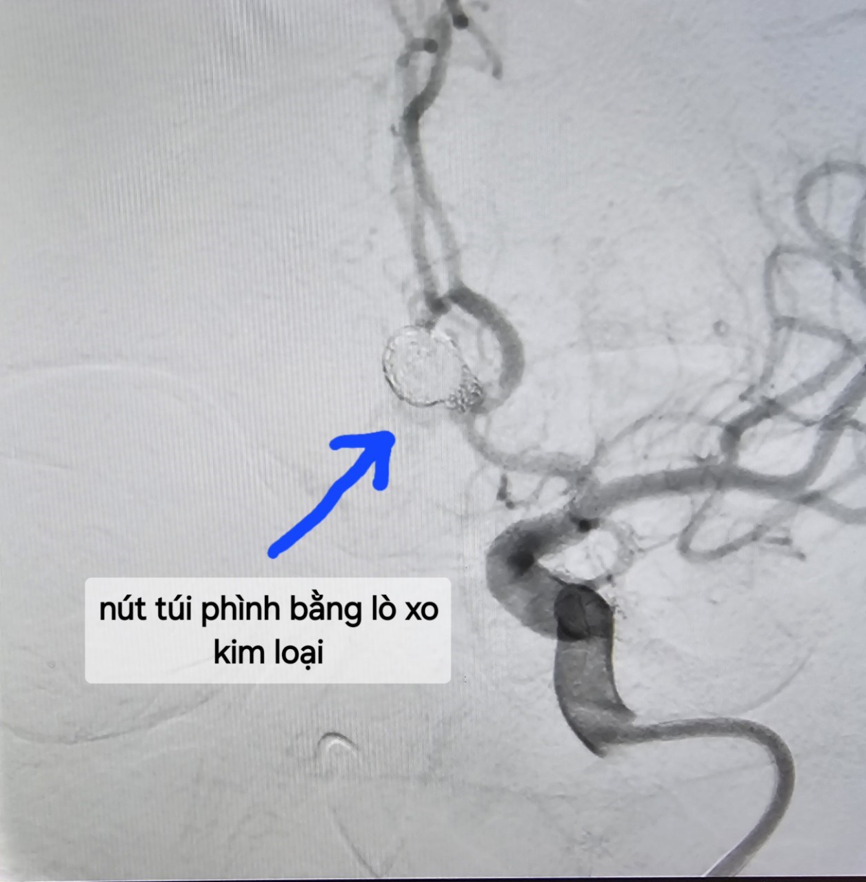 Nút túi phình bằng lò xo kim loại