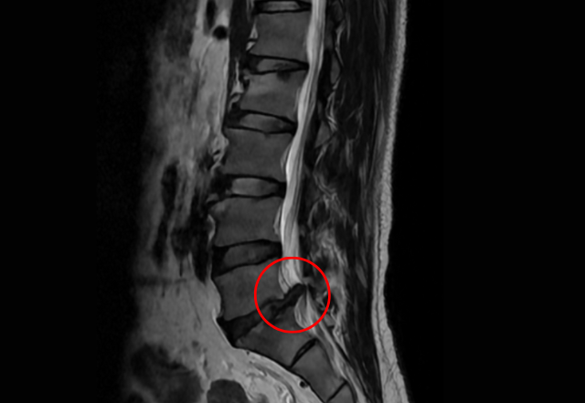 Rách vòng xơ, đĩa đệm L5/S1 chui vào trong ống tủy, chèn ép rễ thần kinh S1