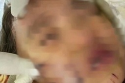 Đang chơi, bé gái 11 tuổi ở Phú Thọ bất ngờ bị chó hàng xóm cắn trọng thương vùng đầu, gáy