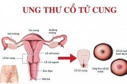 Độ tuổi nào phụ nữ cần tầm soát ung thư cổ tử cung?