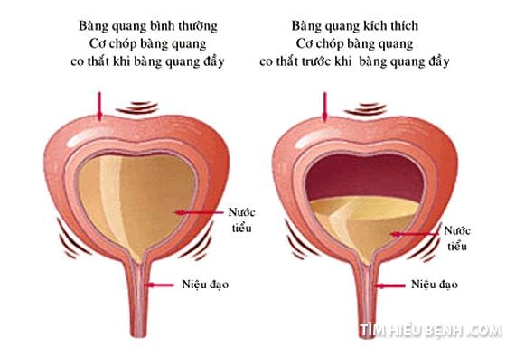 Giải mã bí ẩn về chứng tiểu đêm, buồn tiểu liên tục khi trời mưa lạnh  - 3