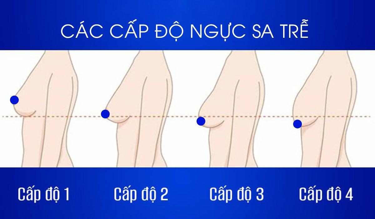 4 cấp độ của ngực sa trễ