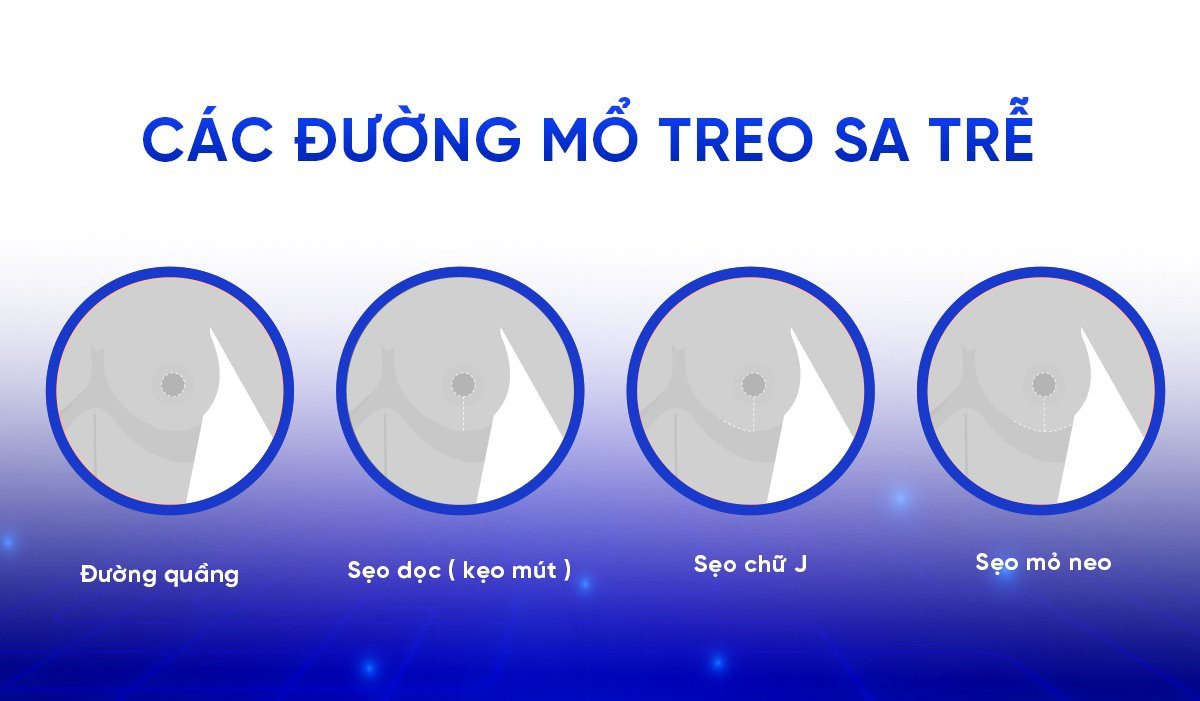 Các đường phẫu thuật treo sa trễ