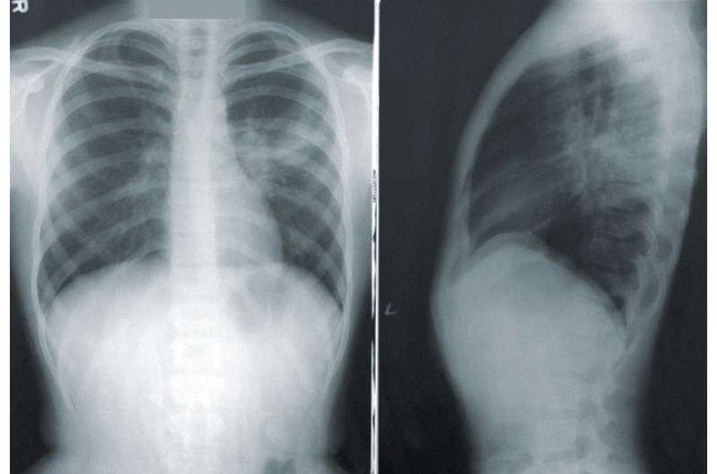 Hình chụp phổi của bệnh nhân ung thư phổi
