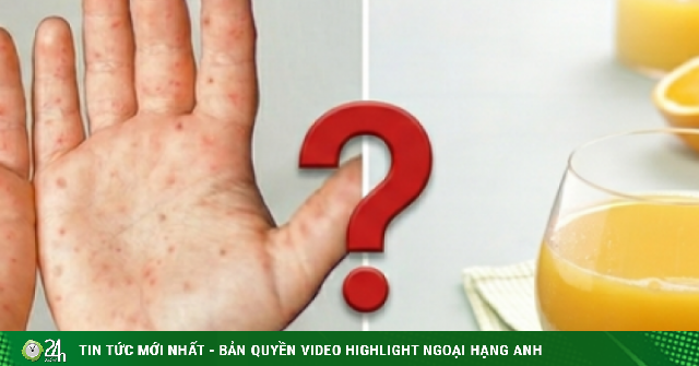 Nước cam tốt nhưng trẻ tay chân miệng nên tránh: Chuyên gia giải thích lý do