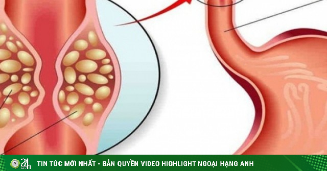 Người đàn ông 50 tuổi phát hiện ung thư dạ dày, tiền ung thư thực quản từ dấu hiệu nhiều người Việt bỏ qua
