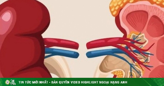 6 loại quả đang bán đầy chợ Việt, người bệnh suy thận nên ăn để kiểm soát bệnh, ngăn ngừa biến chứng