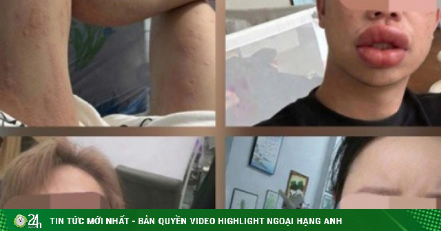 Sưng mắt, môi sau khi ăn bánh trứng kiến: Đặc sản hay 'thủ phạm'?