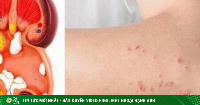 Bất ngờ phát hiện suy thận giai đoạn nặng từ dấu hiệu nhiều người Việt mắc phải nhưng dễ bỏ qua